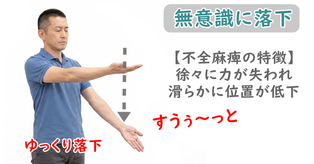 上肢バレー試験を受けている男性。陽性所見である麻痺側の落下がみられる。