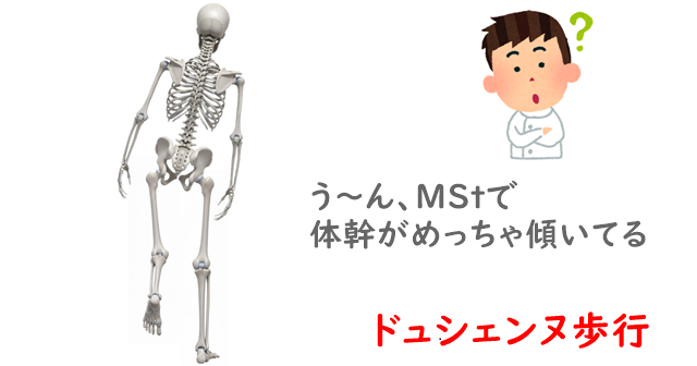 ドュシェンヌ歩行のイラスト。体幹が同側に傾いている解説あり。