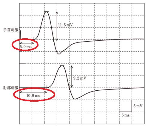神経伝導検査の波形の図。２つの時間の記載場所を強調している。
