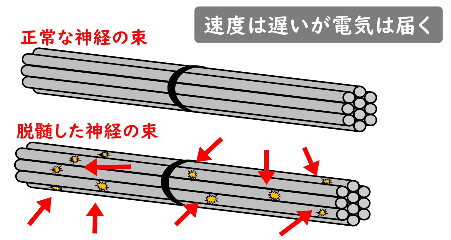 正常な神経と脱髄した神経の比較イラスト。伝導速度が遅延するが電気は届くことを解説。