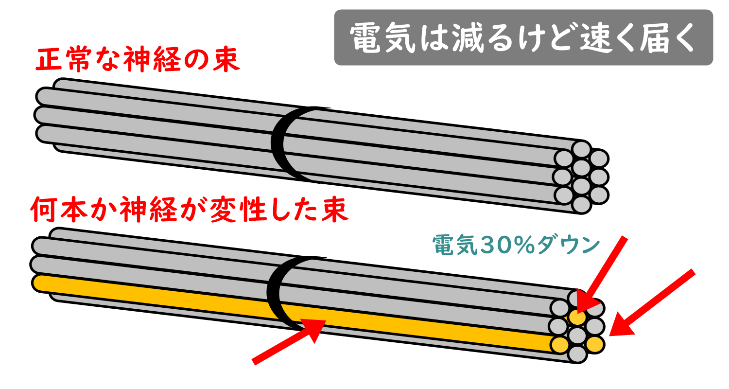 正常な神経と運動ニューロン変性の比較イラスト。電気は減るが速く電動することを解説。