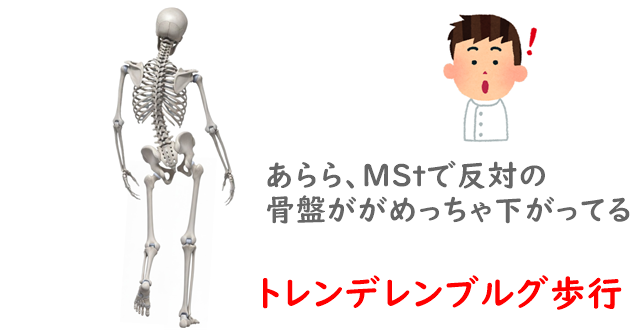 トレンデレンブルグ歩行のイラスト。反対の骨盤が落下している解説あり。