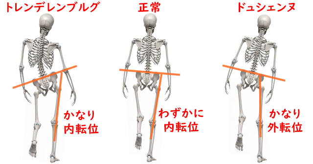 正常歩行、トレンデレンブルグ歩行、ドュシェンヌ歩行を３つ並べたイラスト。それぞれ股関節の解説あり。