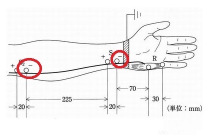 神経伝導検査の問題の図。陰極の場所とどこを距離とするのかを解説。