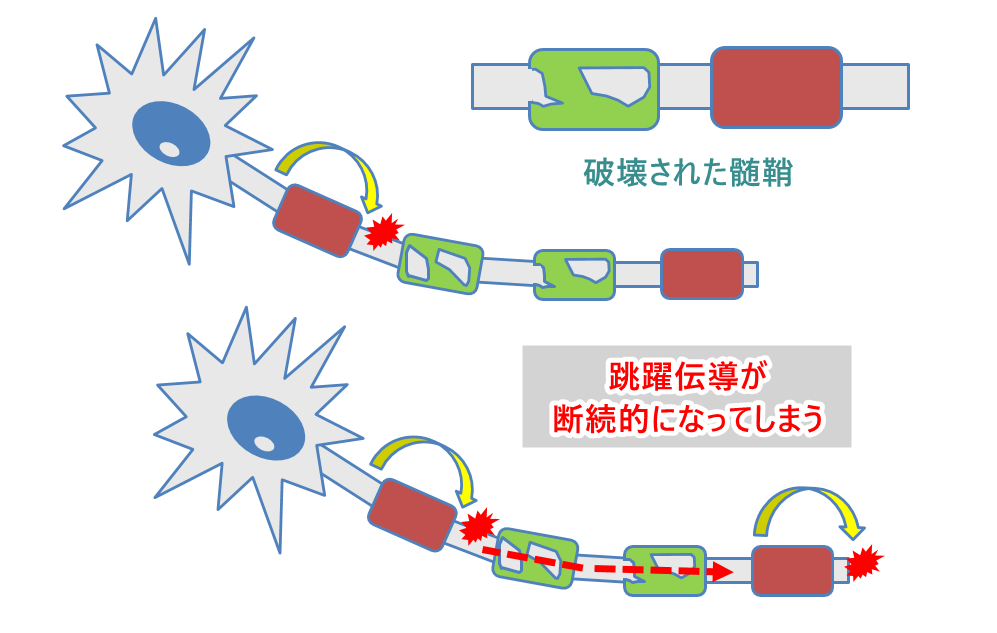神経のイラスト。髄鞘に穴が開いており（脱髄）跳躍伝導がしづらい様子を解説。