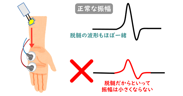 神経伝導検査のイラスト。波形の高さ（電圧）は変わらないことを解説。