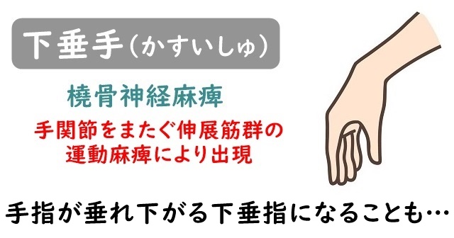 下垂手(かすいしゅ)のイラスト。橈骨神経麻痺により、手関節をまたぐ伸展筋群の運動麻痺により出現。手指が垂れ下がる下垂指になることについても解説。