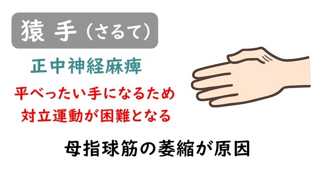 正中神経麻痺による猿手のイラスト。母指球の萎縮による対立運動の障害、中手骨アーチの低下、手掌面の平坦化をテキストにて説明。