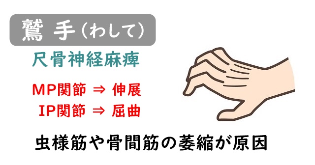 尺骨神経麻痺による鷲手のイラスト。MP関節の伸展とIP関節の屈曲。虫様筋や骨間筋の萎縮についてテキストで解説。