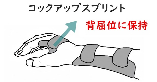 コックアップスプリントのイラスト。手関節を背屈位で固定させる静的装具であることを解説。