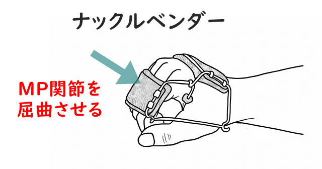 ナックルベンダーのイラスト。MP関節を屈曲位で保持させる動的装具の解説。