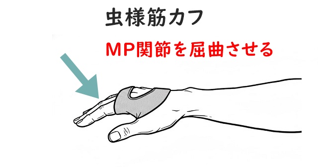 虫様筋カフのイラスト。MP関節を屈曲位で保持させる静的装具の解説。