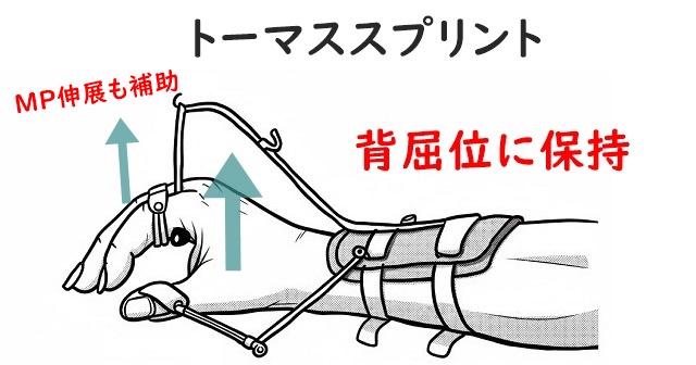 トーマススプリントのイラスト。MP関節伸展と手関節背屈を補助する動的装具であることを解説。