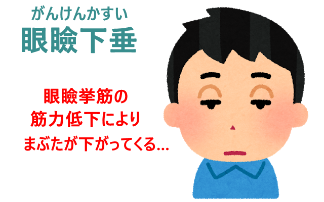 眼瞼下垂のイラスト、眼輪筋の筋力低下を解説。