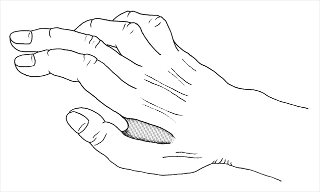 手の背面図:第1背側骨間筋の萎縮