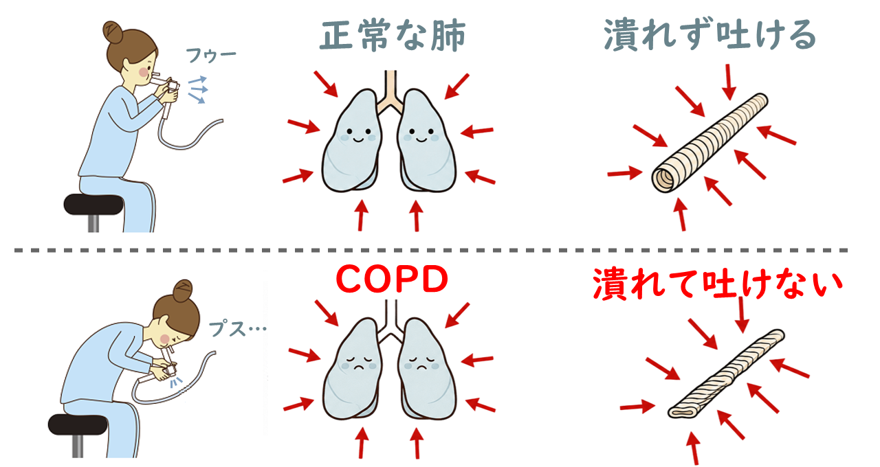 正常とCOPDの肺とそれぞれの気管支の太さを比較したイラスト