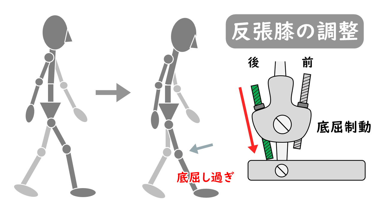 反張膝のイラストと後方ロッドを下げたイラスト