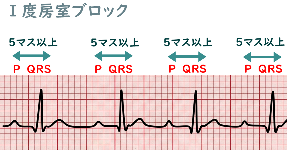 Ⅰ度房室ブロックの心電図波形