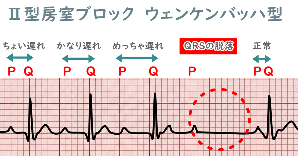 Ⅱ度房室ブロックの心電図波形（ウェンケンバッハ）