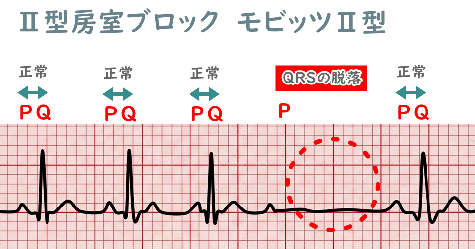Ⅱ度房室ブロックの心電図波形（モビッツⅡ型）