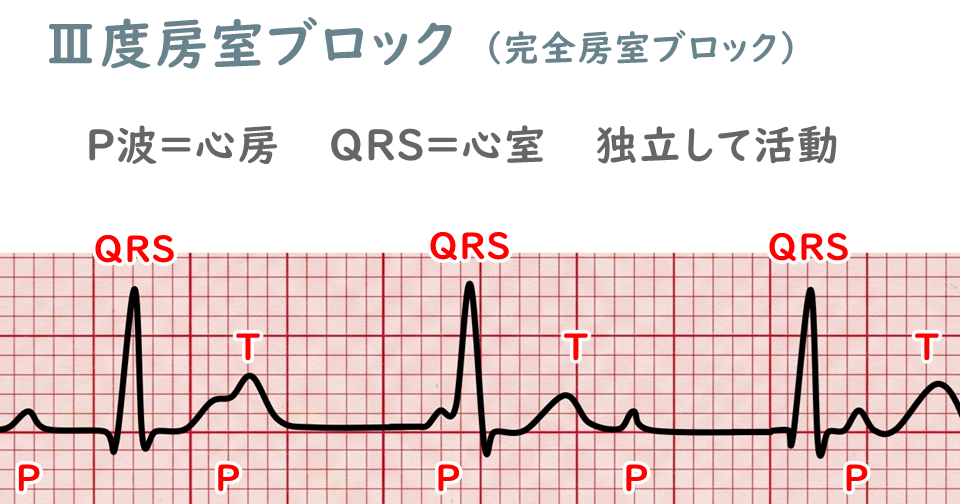 Ⅲ度房室ブロックの心電図波形