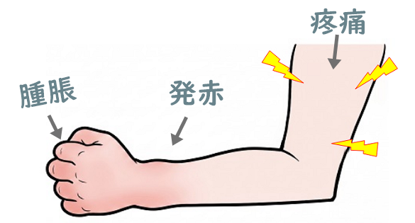 赤くて腫脹している腕のイラスト