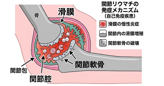 関節包の内側にある滑膜が炎症を起こして増殖している状態を表すイラスト。