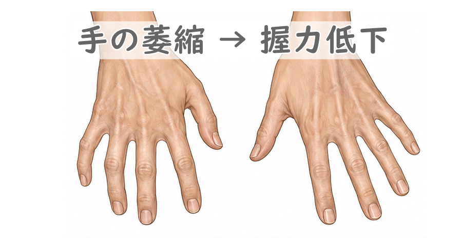 萎縮した手指のイラスト