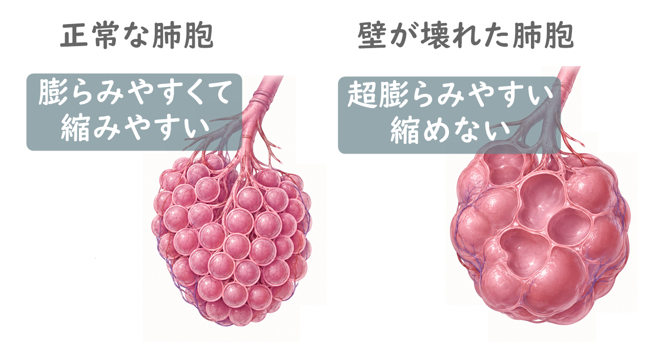 正常な肺胞と、壁が壊れた肺気腫の肺胞の比較イラスト